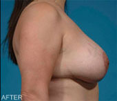 Patient # 71840 After Photo # 6
